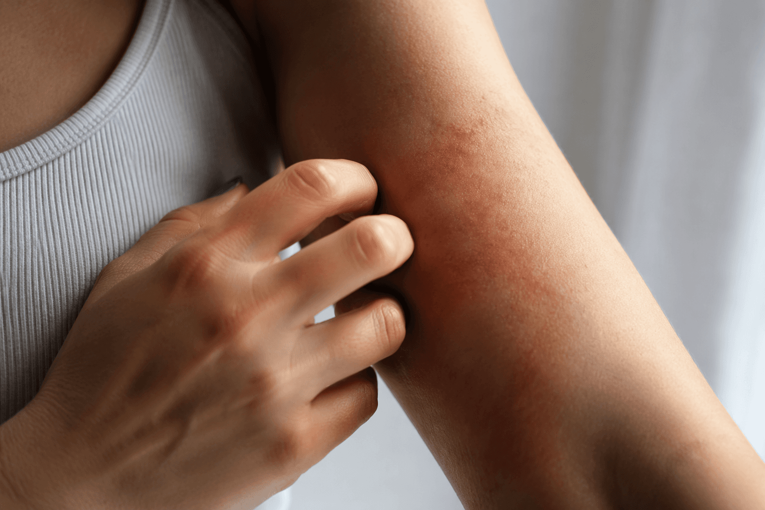 What keto rash is, and why ketosis can trigger it