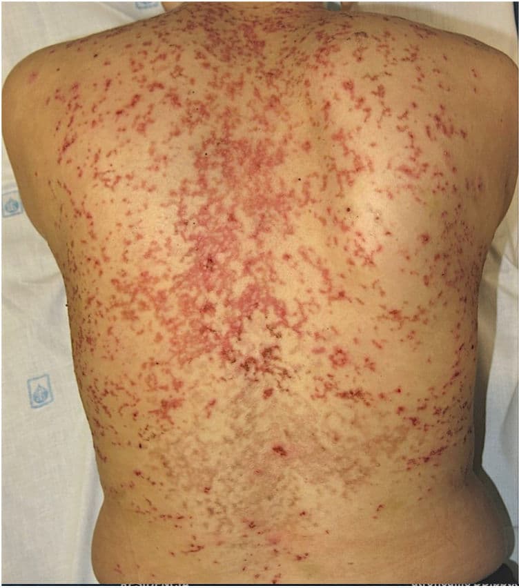 Keto diet linked to itchy rash in JAMA Dermatology case report